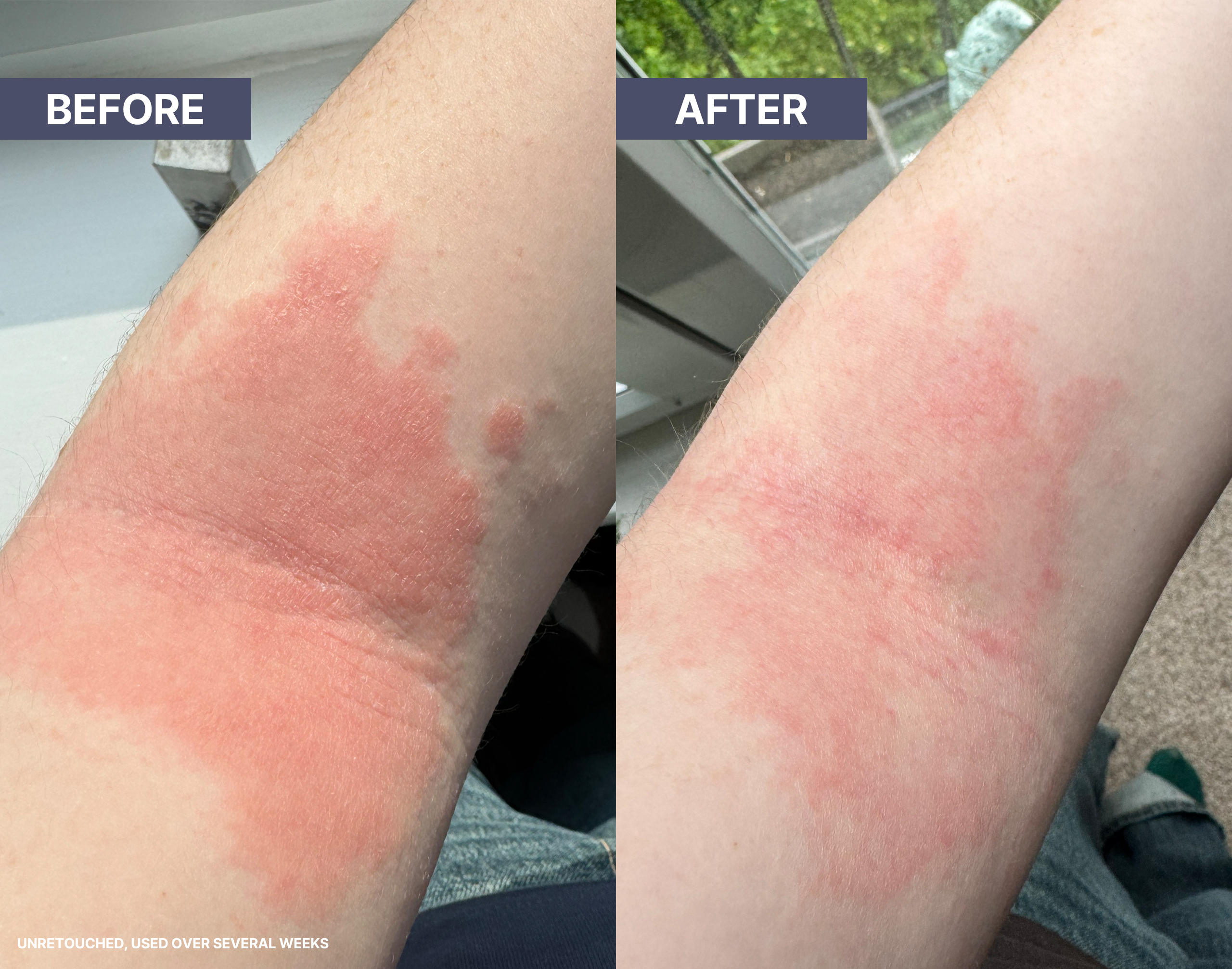 Before & Afters - Paige's Eczema Arm
