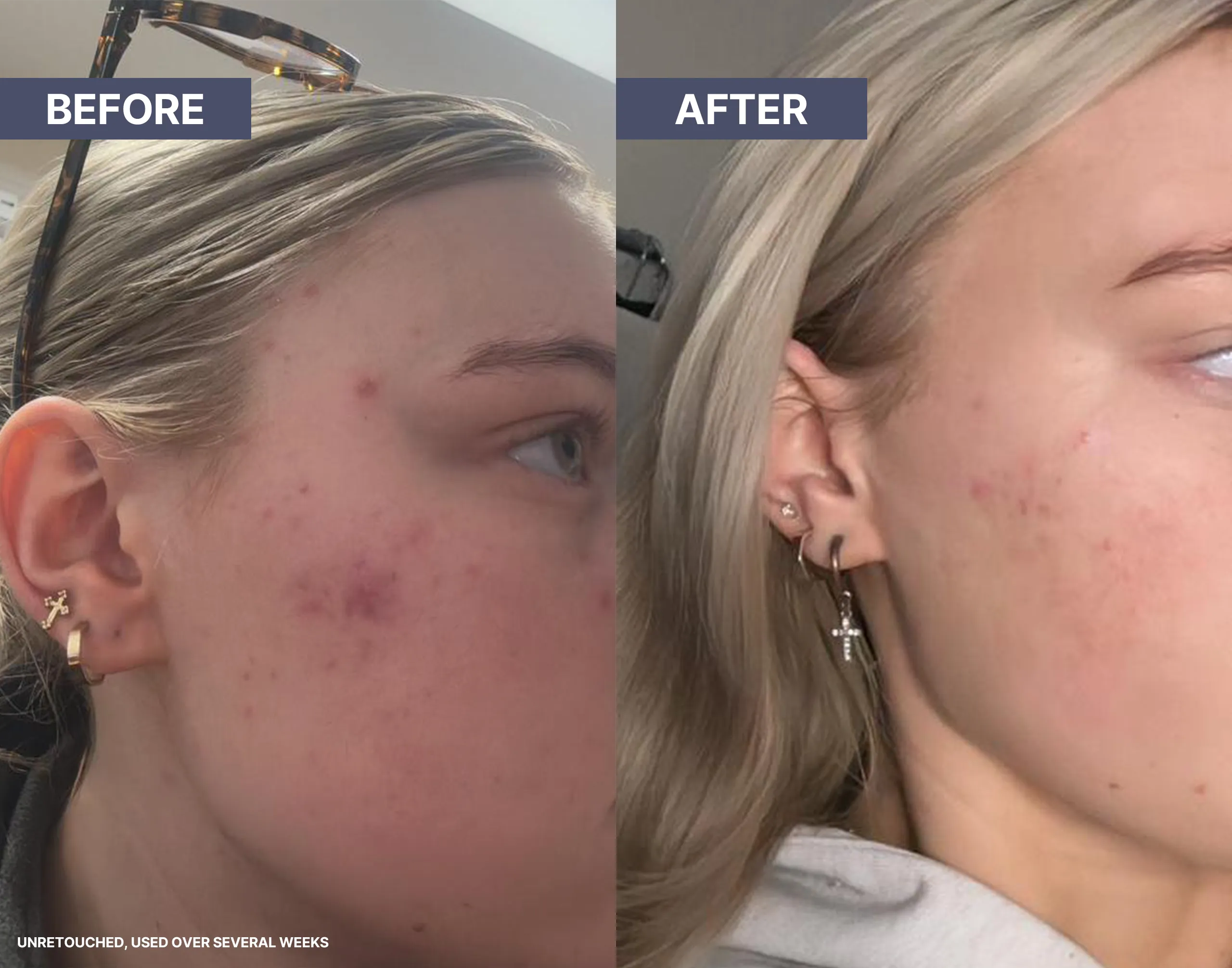 Before and after blemishes repair acne